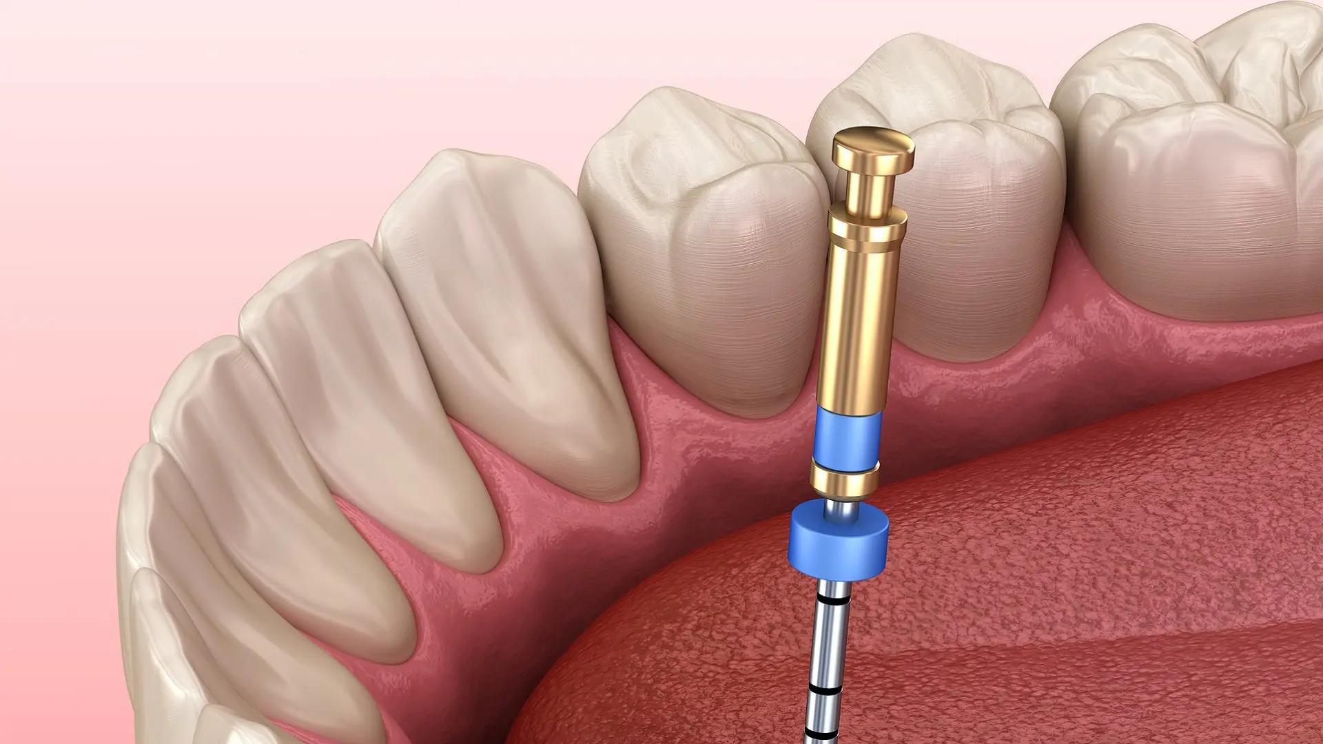عصب کشی (درمان ریشه دندان)