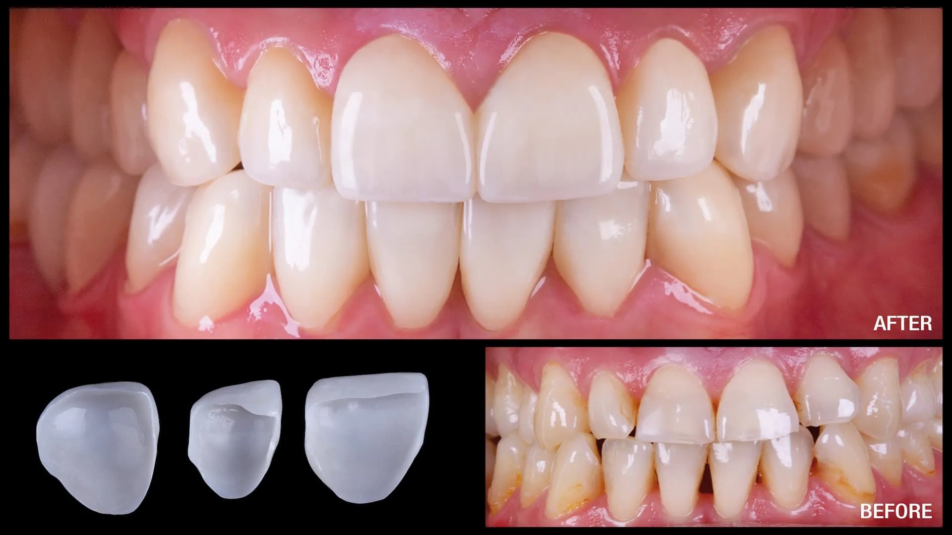 Everything about the difference between zirconia crown and ceramic dental crown
