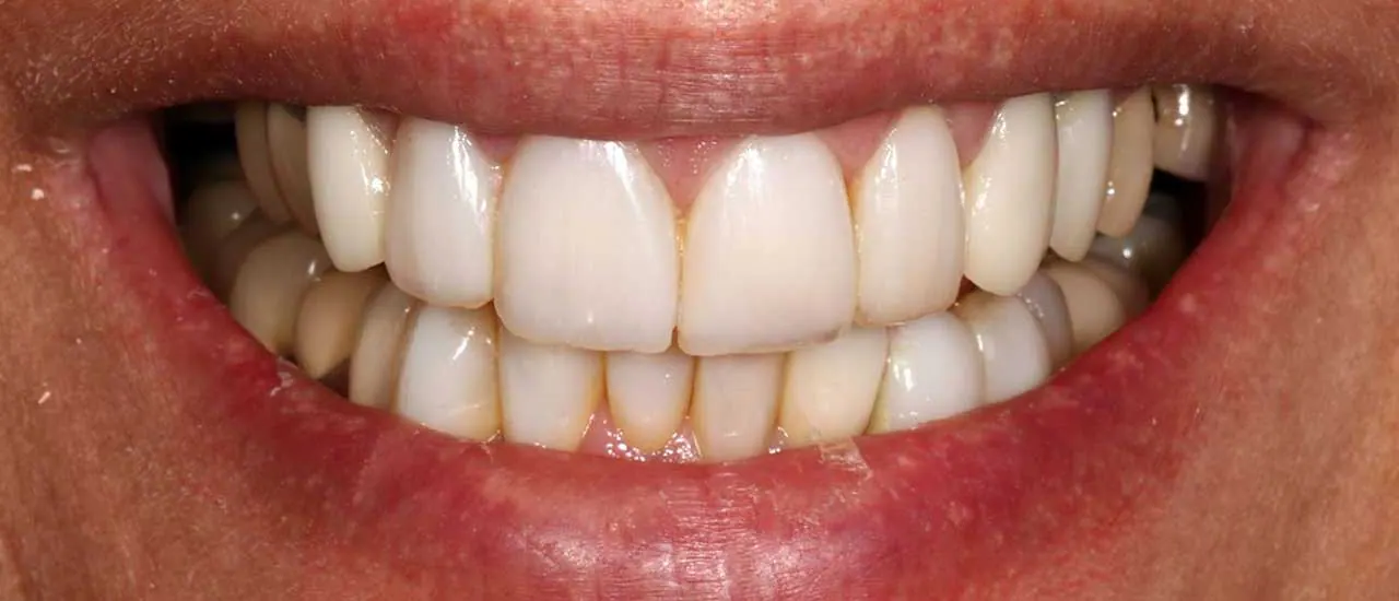 Treatment result
