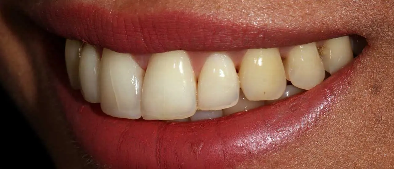 Treatment result