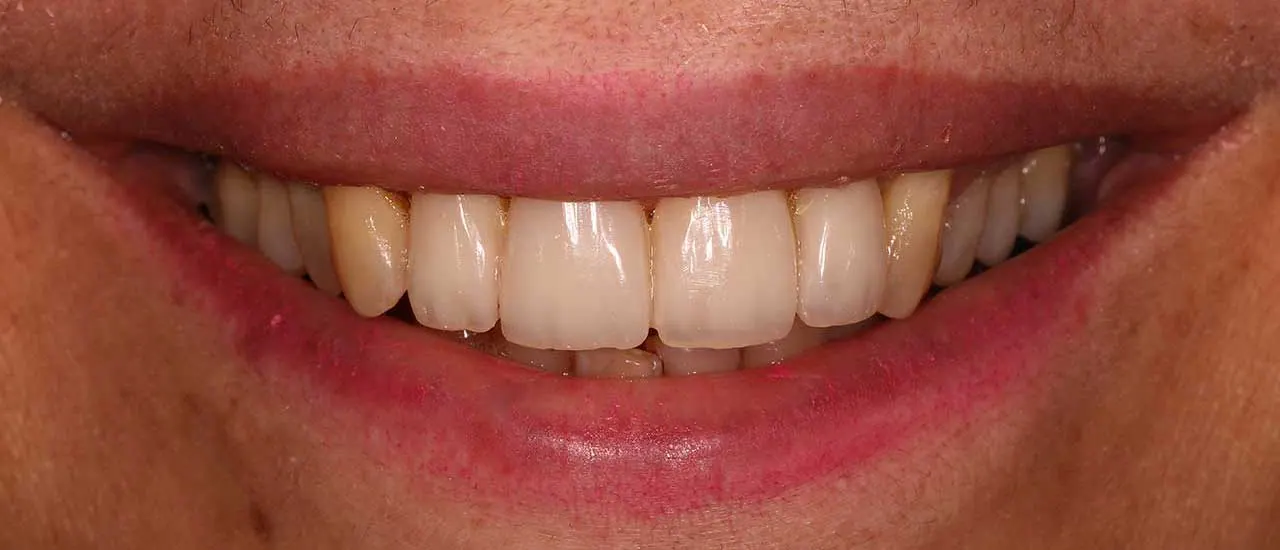 Treatment result