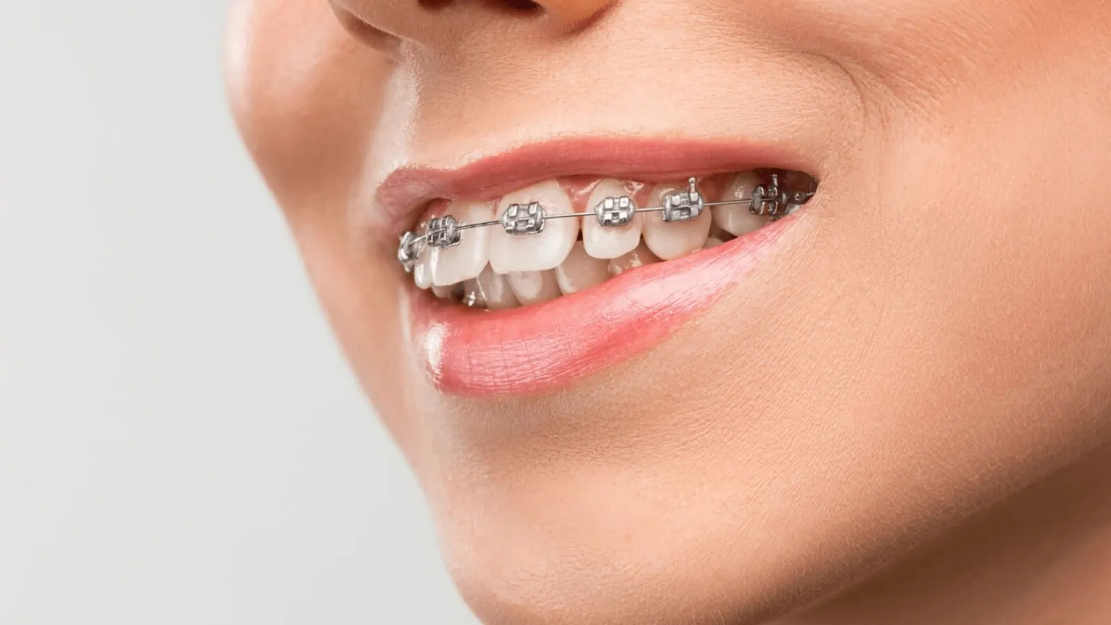 همه چیز درباره ارتودنسی: بهترین سن برای ارتودنسی چه زمانی است؟