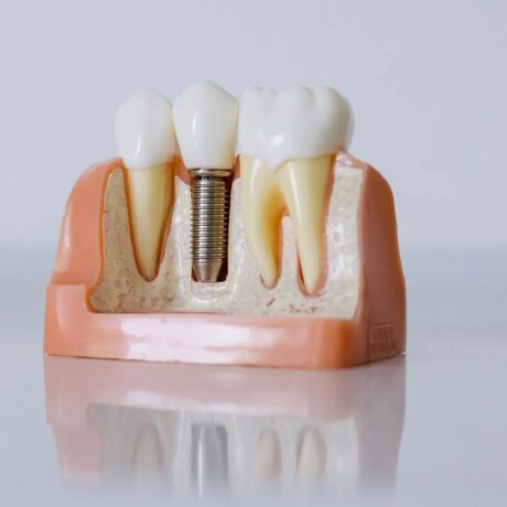 قالب گیری ایمپلنت چند مرحله دارد؟ صفر تا صد قالب گیری ایمپلنت