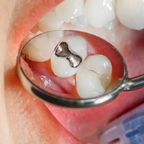 مراقبت بعد از پر کردن دندان، راهی برای افزایش طول عمر دندان