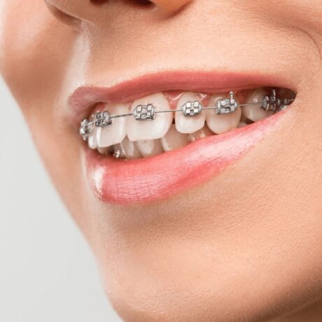 همه چیز درباره ارتودنسی: بهترین سن برای ارتودنسی چه زمانی است؟