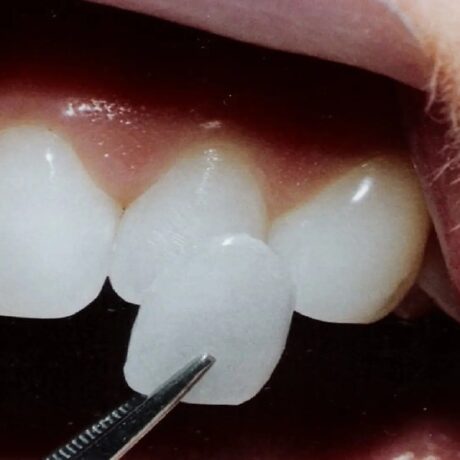 آشنایی با انواع لمینت دندان: کدام لمینت برای من بهتر است؟