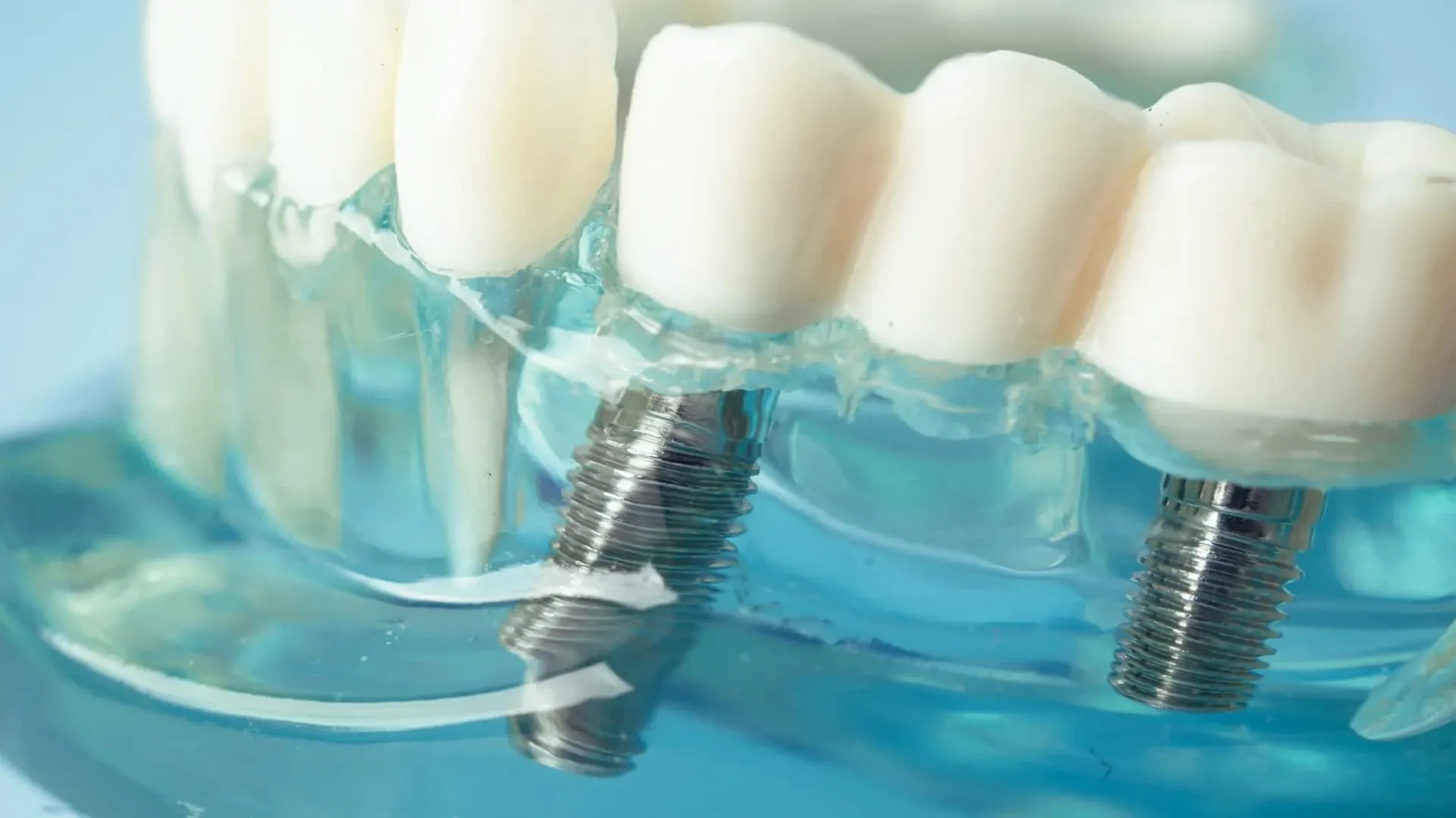 بهترین زمان ایمپلنت: چقدر بعد از کشیدن دندان باید ایمپلنت انجام داد؟