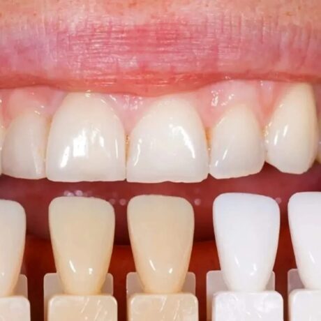 کامپوزیت دندان خرگوشی: اصلاح دندان ها بدون ارتودنسی با بهترین قیمت