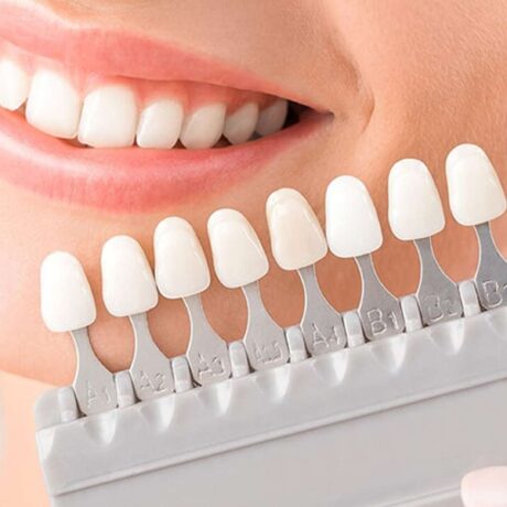 چه مقدار تراشیدن دندان برای لمینت انجام می‌شود؟ + نحوه انجام