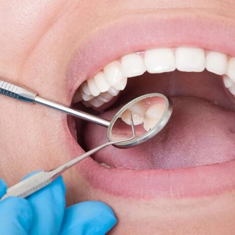 علت تیر کشیدن دندان چیست؟ بهترین درمان تیر کشیدن دندان