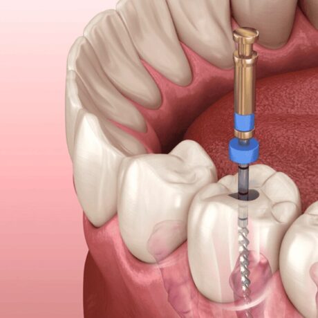 مراقبت های بعد از عصب کشی دندان: راهنمایی جامع برای بهبود سریع دندان درمان شده