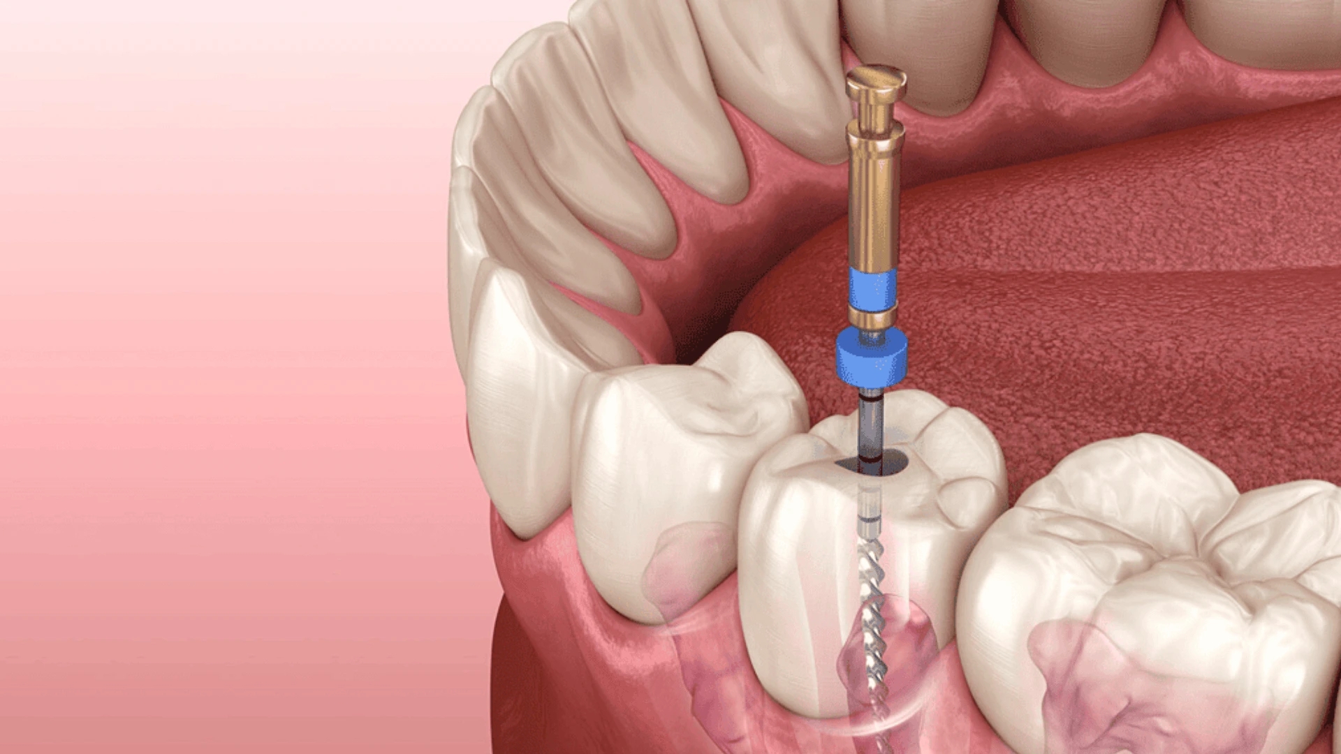 مراقبت های بعد از عصب کشی دندان: راهنمایی جامع برای بهبود سریع دندان درمان شده