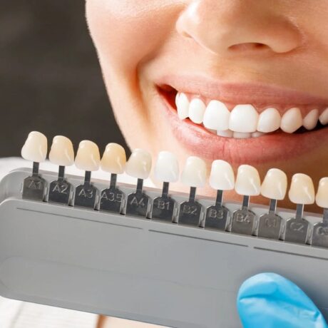 هر واحد لمینت چند دندان است؟ راهنمایی برای تصمیم گیری بهتر