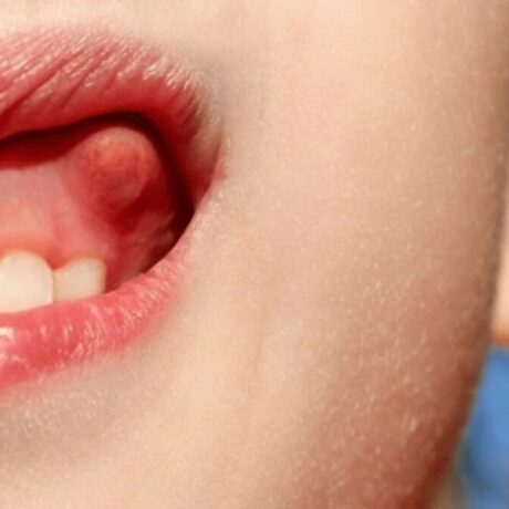 آبسه دندان کودک و بزرگسال: علل بروز، راه‌های پیشگیری و درمان