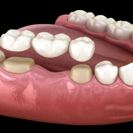 همه چیز درباره روکش دندان شکسته + مزایا و معایب آن