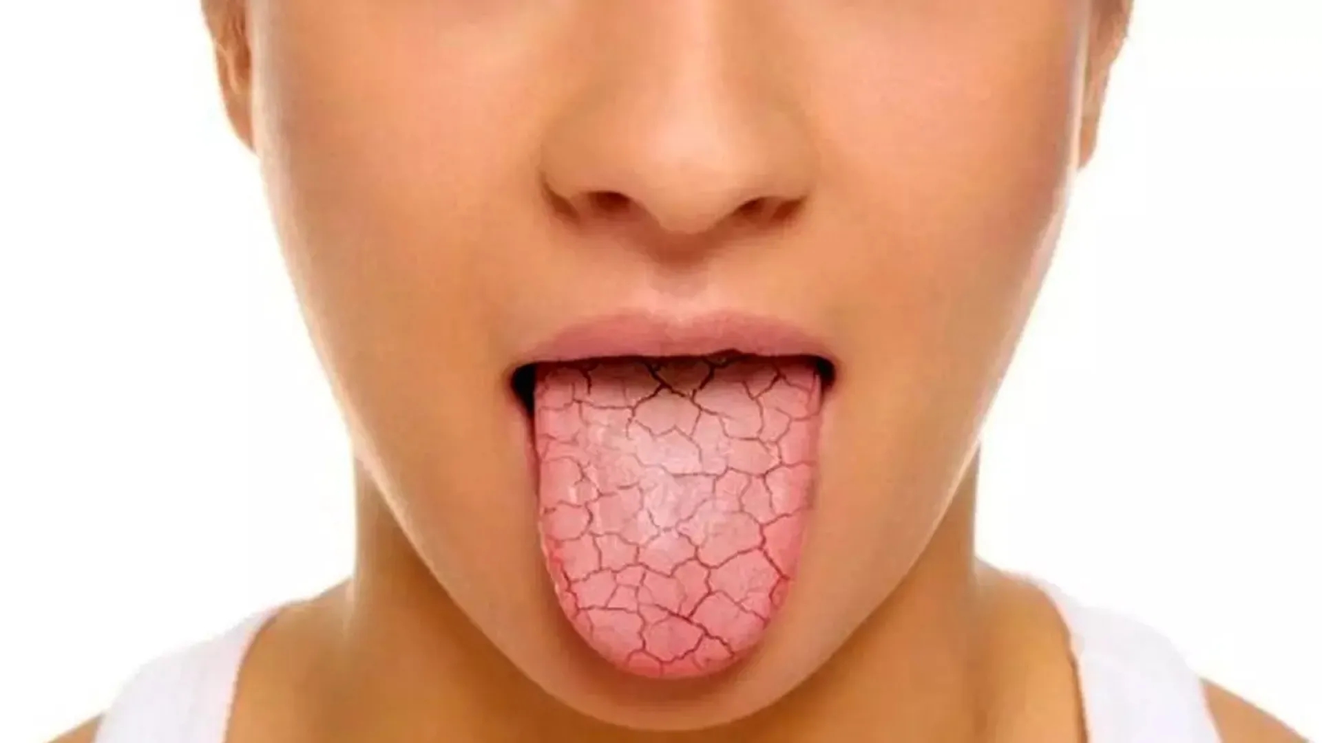 علت خشکی دهان چیست و چه بیماریهایی باعث خشکی دهان میشوند؟