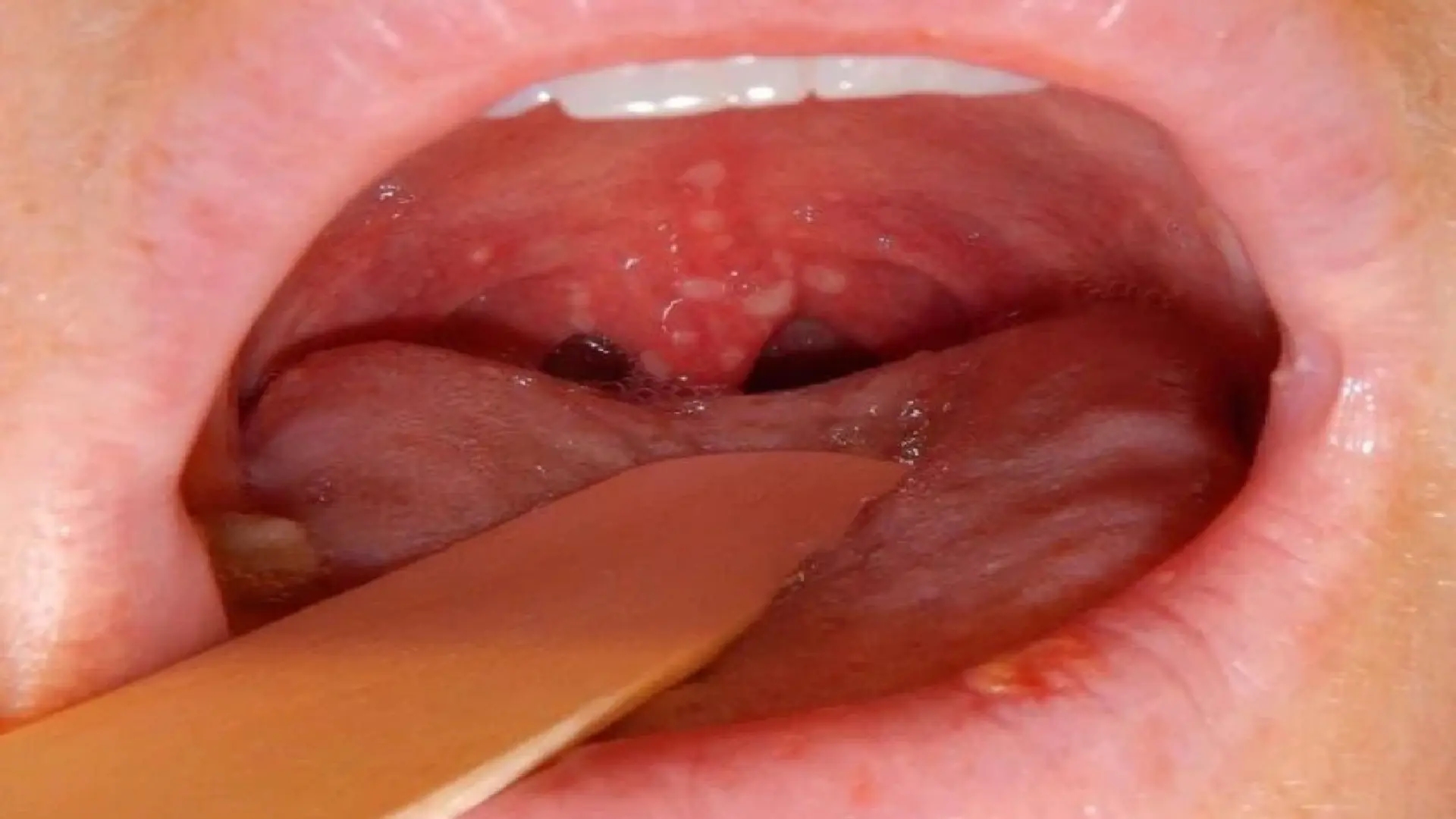 همه چیز درباره زگیل دهان: علائم، روشهای پیشگیری و راههای درمان