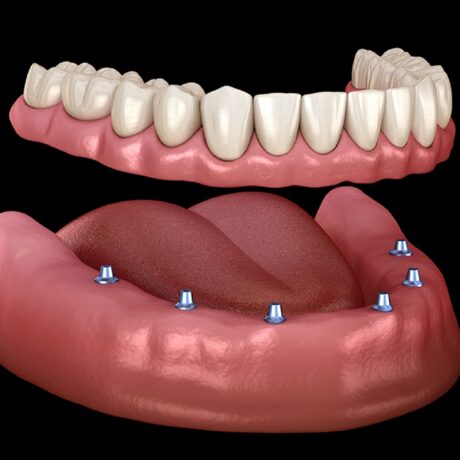 اوردنچر دندان چیست؟ راهنمای جامع از نحوه انجام تا مراقبت‎‌های بعد از آن