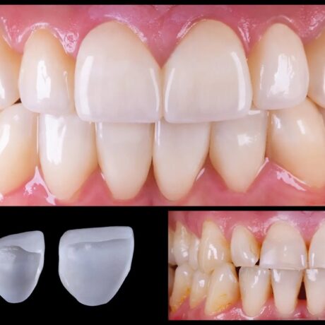 همه چیز درباره فرق روکش زیرکونیا با روکش سرامیک دندان