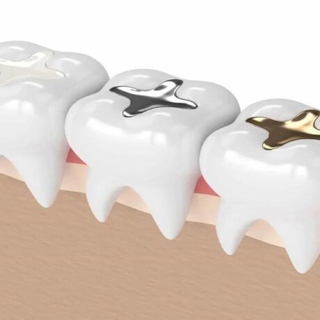 مراقبت بعد از پر کردن دندان: بیش از 10 سال به طول عمر دندان بیفزاید!