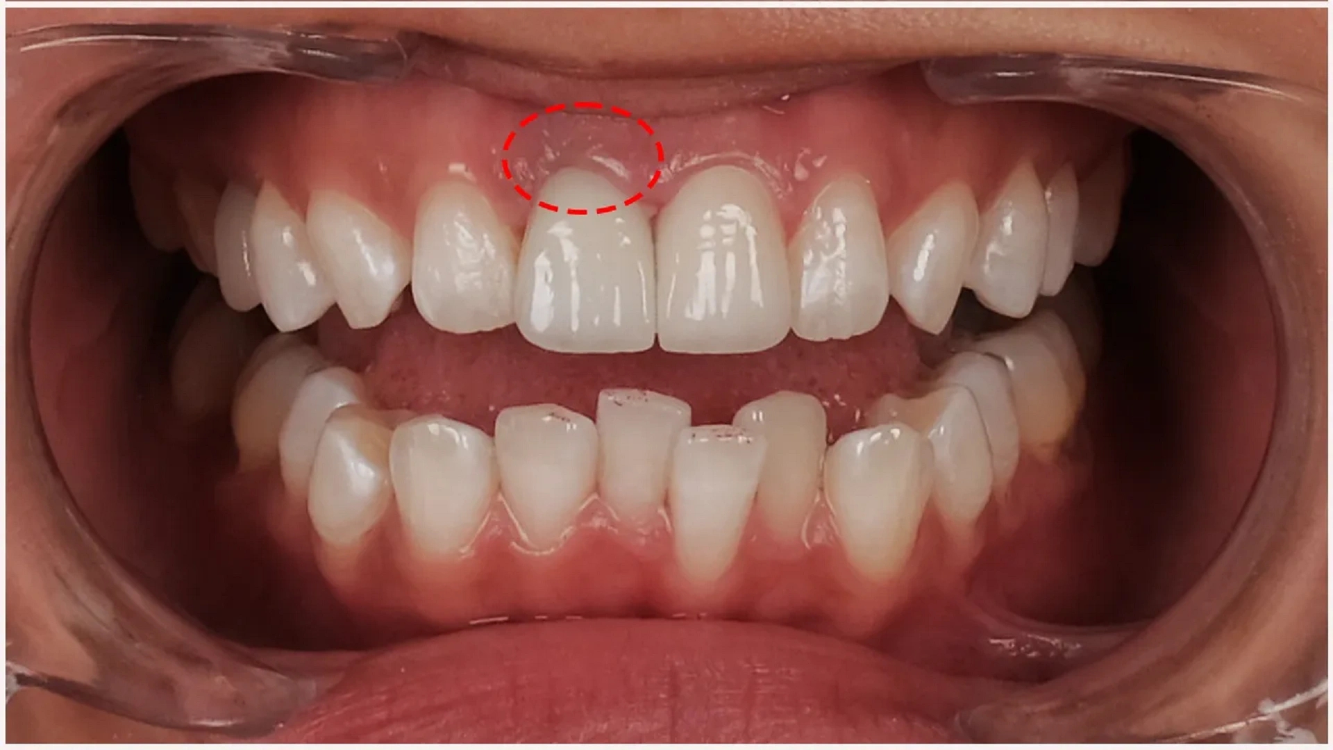 عوارض لمینت دندان چیست؟ روش‌های جلوگیری و مراقبت