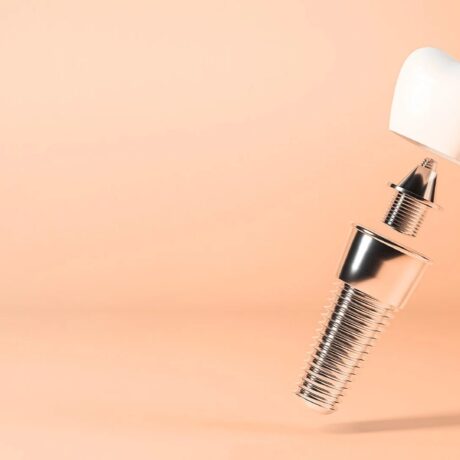 فیکسچر ایمپلنت دندان: راهنمای انتخاب پایه ایمپلنت و بررسی دلایل افتادن آن