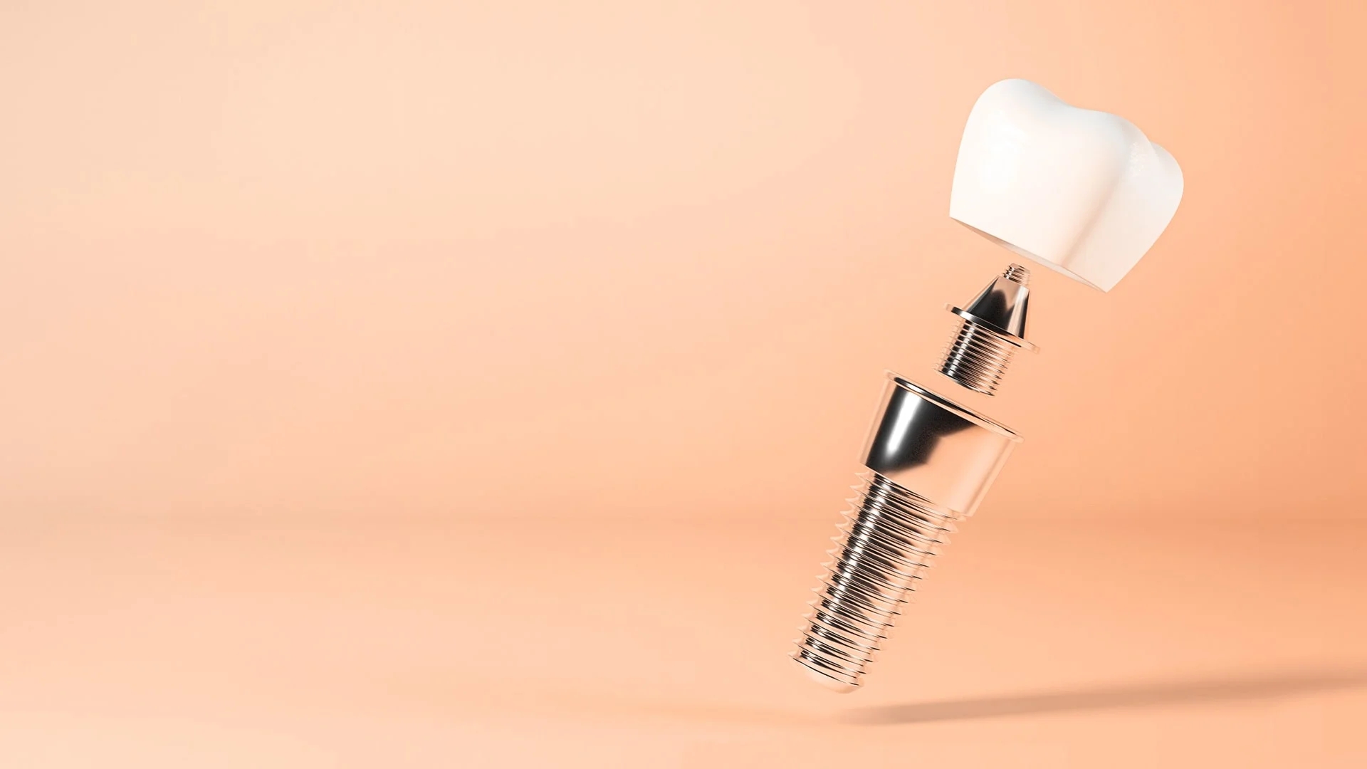 فیکسچر ایمپلنت دندان: راهنمای انتخاب پایه ایمپلنت و بررسی دلایل افتادن آن