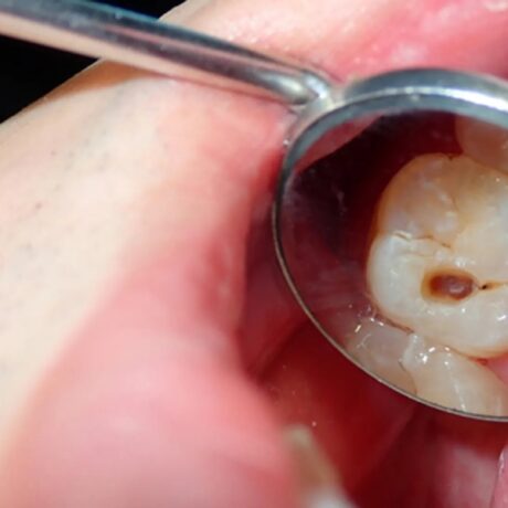 همه چیز درباره اینکه بعد از عصب کشی دندان چه بخوریم؟