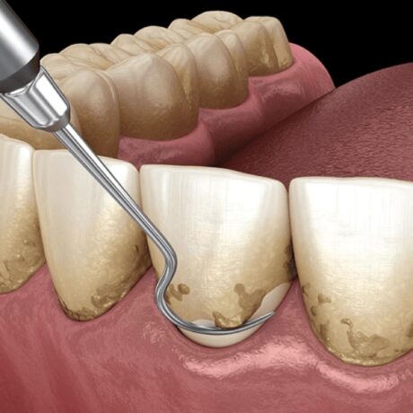 جرم گیری لثه: یک راه حل موثر برای درمان بیماری‌های لثه