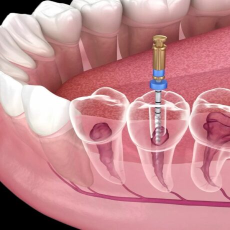 درد دندان بعد از عصب کشی؛ چرا درد بعد از عصب کشی ادامه دارد؟