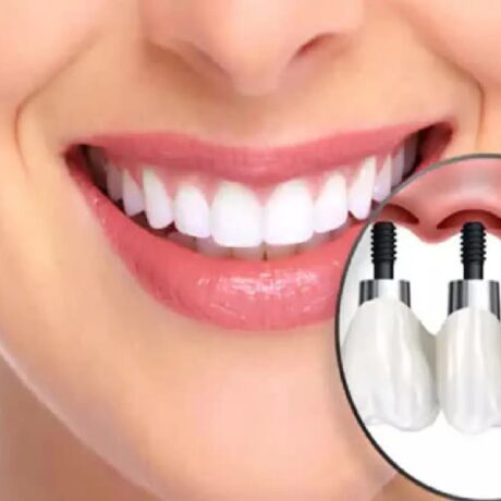 انواع ایمپلنت دندان: برند، جنس و روش‌های کاشت هر نوع ایمپلنت